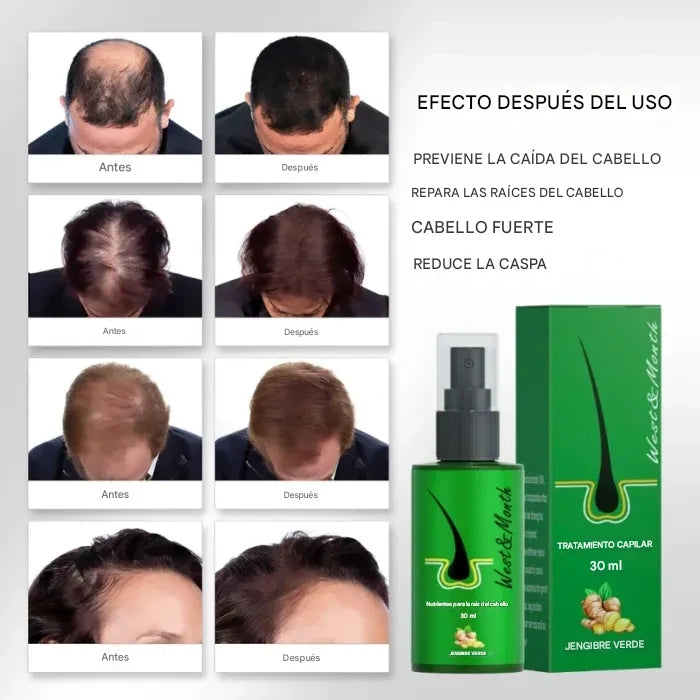 "Spray para el Crecimiento Capilar: Estimula el Crecimiento y Previene la Caída del Cabello"