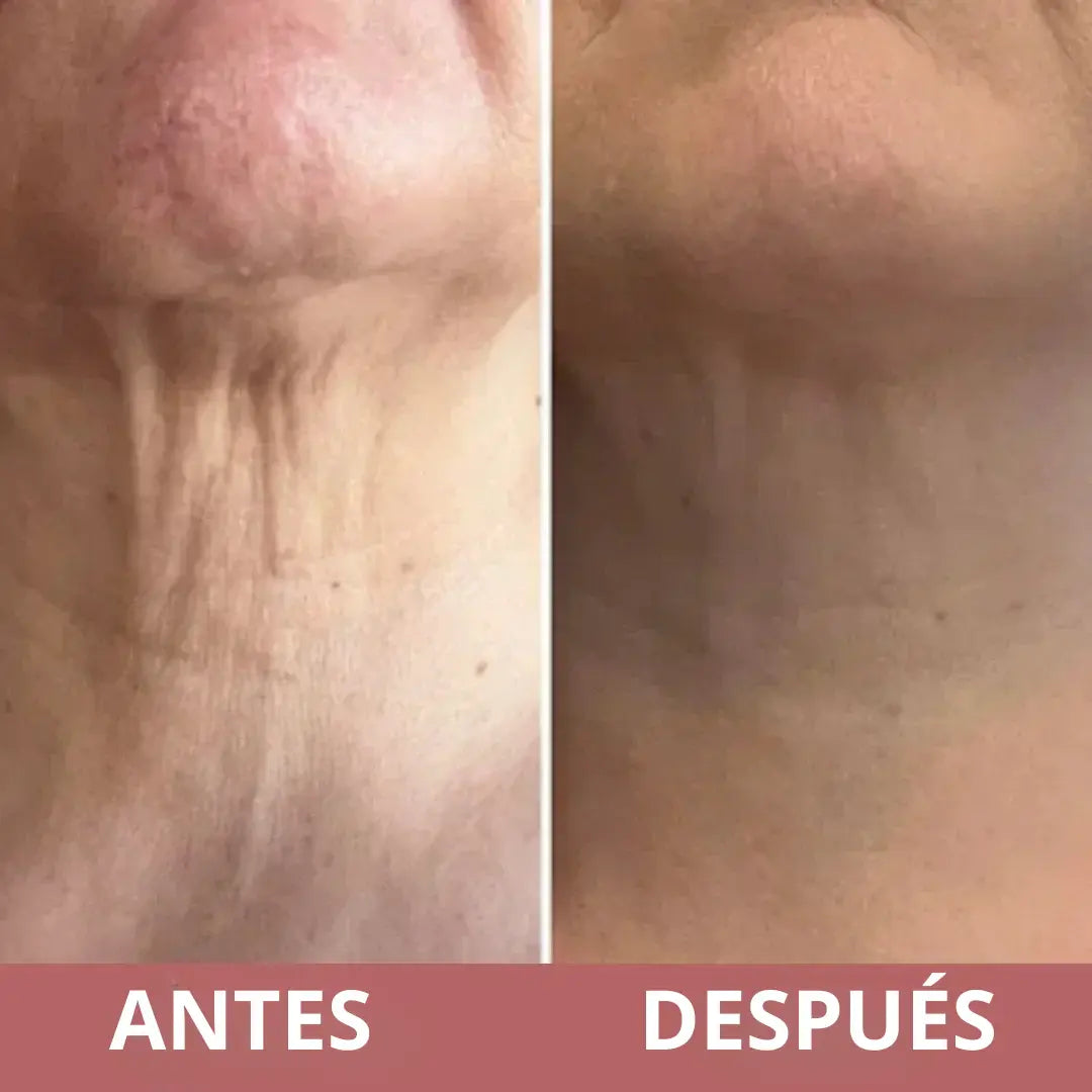 NeckLift Natural ¡Adiós Arrugas y Flacidez!